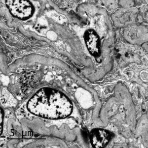 Transmission electron microscopy. Partially occluded capillary lumens with endothelial edema. Glomerular basement membranes irregular, folded, with areas of thickening and variable thickness between 327nm and 491nm. Erasure of podocyte processes associated witn microvillous degeneration.