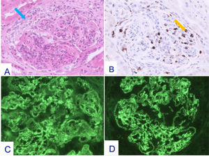 Cambios histopatológicos en la segunda biopsia renal (Dic-2023). Glomérulo en el que se advierte incremento de la celularidad mesangial e hipercelularidad endocapilar junto a proliferación extracapilar en forma de semiluna epitelial (flecha azul) Hematoxilina-eosina x 20 (A). La tinción para CD68 pone de manifiesto incremento de células monocitarias en el interior de capilares glomerulares (flecha amarilla) Inmunoperoxidasa x 20 (B). En el estudio mediante IF directa se advierten depósitos difusos y globales cápilo-mesangiales para IgG (+++) (C) y para C3 (+++) (D). Cambios histopatológicos en la segunda biopsia renal (Dic-2023). Glomérulo en el que se advierte incremento de la celularidad mesangial e hipercelularidad endocapilar junto a proliferación extracapilar en forma de semiluna epitelial (flecha azul) Hematoxilina-eosina x 20 (A). La tinción para CD68 pone de manifiesto incremento de células monocitarias en el interior de capilares glomerulares (flecha amarilla) Inmunoperoxidasa x 20 (B). En el estudio mediante IF directa se advierten depósitos difusos y globales cápilo-mesangiales para IgG (+++) (C) y para C3 (+++) (D).