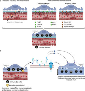 Fig. a, b. Pathophysiology of membranous nephropathy. Primary membranous nephropathy is characterized by the formation of subepithelial immune deposits, composed of autoantigens and immunoglobulins, located beneath the podocyte basement membrane. The loss of self-tolerance to podocyte antigens, most frequently the phospholipase A2 receptor, likely reflects the interaction between genetic susceptibility, environmental factors, and dysregulated antigen expression. The binding of circulating autoantibodies to podocyte antigens initiates complement activation, leading to the formation of the membrane attack complex (C5b–9). This results in significant podocyte injury, increased calcium influx, cytoskeleton disruption, and loss of slit diaphragms. The lectin and alternative complement pathways appear to be the main mediators of the damage, while activation via the classical pathway is limited. Complement-derived mediators, such as C3a and C5a, further amplify podocyte injury through maladaptive signaling, culminating in proteinuria and progressive remodeling of the glomerular basement membrane.49 Created in https://BioRender.com. BSA, cationic bovine serum albumin; ERT, enzyme replacement therapy; PLA2R, phospholipase A2 receptor; THSD7A, thrombospondin type-1 domain-containing protein 7A; NELL1, neural epidermal growth factor-like protein 1; PCDH7, protocadherin 7; NCAM1, neural cell adhesion molecule 1.