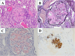 A-D) Glomérulo con depósito mesangial de material eosinófilo amorfo por hematoxilina-eosina (A), no argirofílico con la tinción de plata-metenamina (B). El rojo Congo muestra positividad de dichos depósitos a nivel mesangial (C), confirmando depósito de amiloide AA por inmunohistoquímica (D). Magnificación ×400.