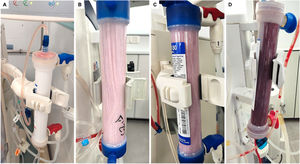 Visual grading scale for extracorporeal circuit (ECC) clotting at the end of hemodialysis sessions. Representative examples of the four clotting categories used in routine clinical assessment: (A) clean capillaries or minimal fibrin deposits; (B) mild to moderate clotting with fibrin present in multiple capillaries; (C) severe clotting with clots present in chambers or blood lines; (D) complete clotting of the dialyzer or extracorporeal circuit.