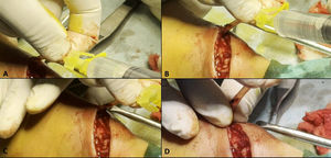 Technique of intraoperative cephalic vein dilatation, A and B – heparinised saline instillation by inserting cannula into distal cut end of cephalic vein, C – proximal pressure being applied by assistant