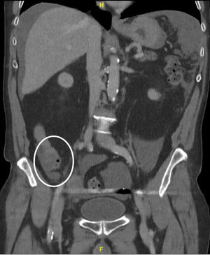 TC abdominal, que muestra engrosamiento del extremo distal del apéndice, con cambios inflamatorios en la grasa adyacente y presencia de burbujas de aire extraluminal; hallazgos compatibles con apendicitis aguda perforada.