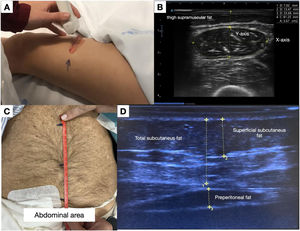 (A) Anatomical location of the ultrasound measurement point at the distal third of the imaginary line connecting the anterior superior iliac spine and the superior border of the patella. (B) Ultrasound image of the quadriceps rectus femoris (QRF), showing the X- and Y-axes and the traced cross-sectional area. (C) Location of the measurement point, midway between the xiphoid process and the umbilicus. (D) Ultrasound image showing the different layers of abdominal fat.