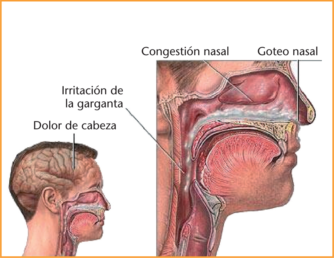 Congestión Nasal