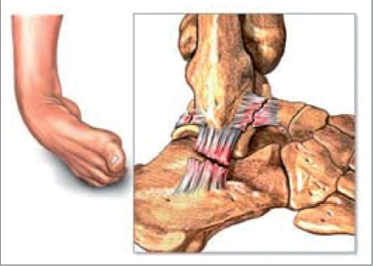 Tobilleras para esguinces de tobillo - Blog sobre ortopedia de