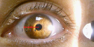 Prueba de la linterna en ojo izquierdo. Grado 4. Grado 1: ausencia de sombra. Grado 2: menos de un tercio de sombra desde el centro de la pupila al limbo esclerocorneal. Grado 3: de un tercio a mitad sombreada desde el centro de la pupila al limbo esclerocorneal. Grado 4: más de mitad sombreada desde el centro de la pupila al limbo esclerocorneal.