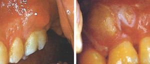 Absceso periodontal.