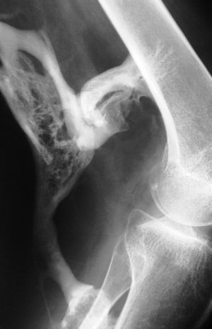Osificación heterotópica masiva en la parte posterior de la rodilla con formación de puentes óseos de aspecto lamelar maduro entre el fémur y la tibia conectados por estructuras de aspecto seudoarticular.