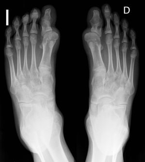Displasia del primer metatarsiano y deformidad en hallux valgus (bilateral) que caracterizan a la enfermedad, así como sinostosis de las articulaciones interfalángicas en ambos primeros dedos.