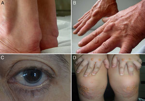 Signos de hipercolesterolemia familiar. A, B)Xantomas en el tendón de Aquiles y en los extensores de la mano. C)Arco corneal completo en un varón <45años. D)Xantomas eruptivos y planos en manos y rodillas de un niño de 5años con HFHo. (Fotos cortesía de la Fundación Hipercolesterolemia Familiar.) Reproducido de Expert Review of Cardiovascular Therapy, March 2013, Vol. 11, No. 3, Pages 327-342, con permiso de Expert Reviews Ltd.