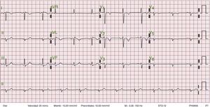 Electrocardiograma.