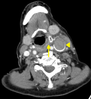 Corte axial de tomografía computarizada cervical con contraste intravenoso a nivel de mandíbula, hioides y cuernos superiores de cartílago tiroides en el que se visualiza la vena yugular interna izquierda completamente trombosada, con el interior del vaso hipodenso y una captación en anillo (punta de flecha). El seno piriforme izquierdo está colapsado (flecha), comparado con el derecho, en el que se objetiva una imagen con densidad aire.