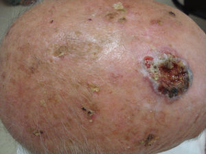 Campo de cancerización con carcinoma epidermoide.