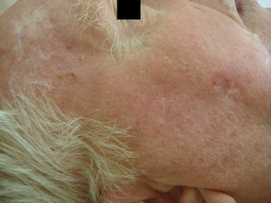 Múltiples queratosis actínicas previas al tratamiento.