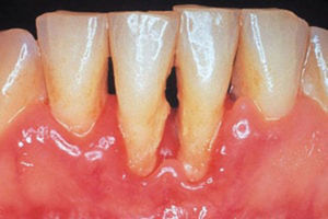 Periodontitis.