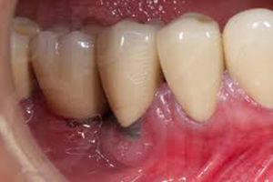 Periimplantitis.