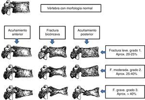 Clasificación de fractura vertebral según Genant. La fractura vertebral viene definida como pérdida de al menos un 20% de la altura vertebral global o, en su porción anterior, media o posterior, con respecto a la vértebra adyacente o disminución de la altura vertebral de más de 4mm con respecto a los controles previos. Fuente: modificado de Genant et al.18.