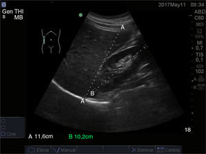 Corte longitudinal medioclavicular sobre lóbulo hepático derecho. A) Hígado. B: riñón derecho.