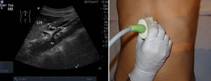 Sonda en disposición longitudinal a nivel de epigastrio. Conseguimos un corte transversal del páncreas (P), con el lóbulo hepático izquierdo (LHI), eje esplenoportal (eep), arteria mesentérica superior (ams), tronco celiaco (Tc), vena renal izquierda (vri) y aorta (Ao).