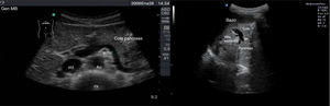A la izquierda, imagen de la cola del páncreas conseguida con la sonda en disposición oblicua a nivel de epigastrio apuntando hacia el hombro izquierdo del paciente, con la arteria mesentérica superior (ams), aorta (Ao), vena cava inferior (VCI) y cuerpo vertebral (CV). A la derecha, visualización de la cola del páncreas a través de la ventana del bazo.