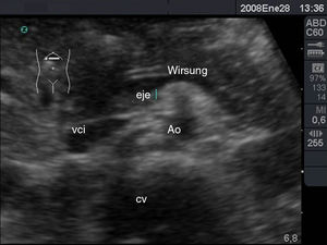 . Corte transversal en epigastrio: conducto de Wirsung, eje esplenoportal, vena cava inferior (vci), aorta (Ao) y cuerpo vertebral (CV).