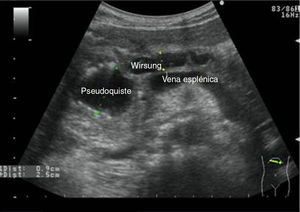 Corte transversal en epigastrio: pancreatitis crónica, con dilatación del conducto de Wirsung y seudoquiste de cabeza de páncreas.