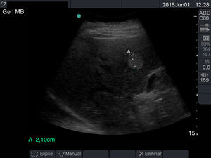 Lesión hiperecogénica correspondiente a un hemangioma hepático.