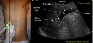 Posición del paciente y la sonda para el estudio de la vesícula biliar (izquierda). Imagen de la vesícula biliar con sus partes (infundíbulo, cuerpo y fondo) y los artefactos de reverberación y refuerzo acústico posterior (derecha).