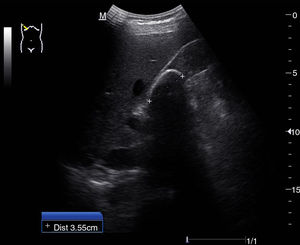 Imagen hiperecogénica en el interior de la vesícula biliar con sombra acústica posterior, correspondiente a litiasis biliar.