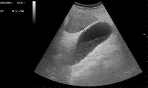 Aumento de grosor de la vesícula medida en su pared anterior, y nivel de ecodensidad intermedia correspondiente a barro biliar en un caso de colecistitis.