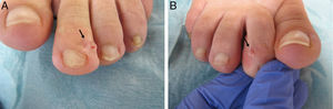 A. Contenido gelatinoso tras la punción del quiste del dedo del pie izquierdo (flecha). B. Material gelatinoso claro de lesión quística en el segundo dedo del pie derecho (flecha).
