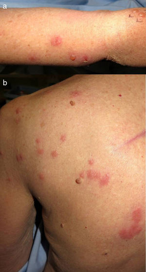 (a). Pápulas eritematosas y ampollas en el antebrazo. (b) Múltiples pápulas eritematosas, algunas de ellas agrupadas, en la espalda.