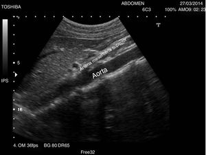 Imagen ecográfica de corte longitudinal a la izquierda de la línea media, donde se visualiza la aorta abdominal proximal y el nacimiento de los grandes vasos (tronco celíaco y arteria mesentérica superior).