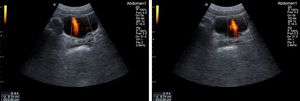 Visualización de los jets ureterales derecho e izquierdo de un paciente con cólico renal, lo que indica permeabilidad de los uréteres.
