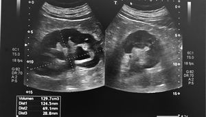 Hidronefrosis que afecta a sistema calicial medio e inferior de riñón izquierdo en un caso de cólico renal expulsivo.