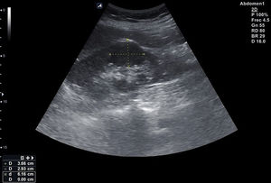 Imagen sólida levemente hipoecogénica con efecto masa en polo inferior del riñón izquierdo correspondiente a un hipernefroma.