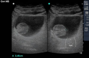 Imagen sólida hiperecogénica en vejiga en sección transversal correspondiente a tumoración exofítica de 3,45cm (carcinoma de células transicionales).