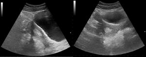 Imagen de un útero normal en corte longitudinal (izquierda) y transversal (derecha), con endometrio engrosado al estar en fase lútea del ciclo.