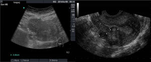 Imagen ecográfica de leiomiomas con sonda abdominal (izquierda, mioma subseroso) y transvaginal (derecha, uno submucoso y 2 subserosos).