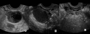 Imágenes ecográficas de distintas masas ováricas: A) cuerpo lúteo hemorrágico; B) endometrioma; C) teratoma ovárico.