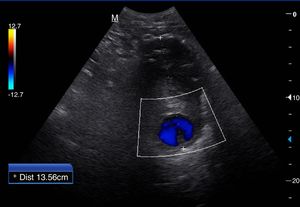 Imagen de un gran aneurisma de aorta abdominal en corte transversal, en la que se observa un gran trombo intramural.