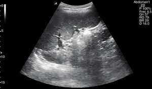 Imagen ecográfica de corte intercostal oblicuo en línea axilar posterior izquierda, donde se aprecia corte coronal del bazo y se identifica su diámetro longitudinal máximo.