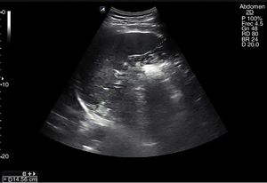 Esplenomegalia de más de 14cm en corte coronal.