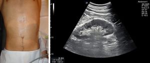 Visualización del riñón izquierdo mediante corte subcostal en línea axilar posterior izquierda.