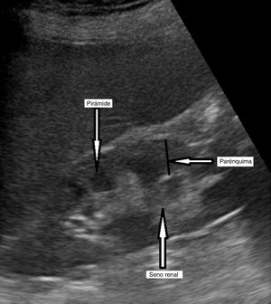 Riñón derecho normal: aspecto hiperecogénico del seno renal y visualización de una pirámide de Malpigio, hipoecogénica respecto al resto del parénquima.