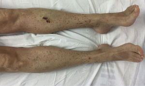 Púrpura palpable en miembros inferiores, se observan puntos de sutura en miembro inferior izquierdo en relación con biopsia cutánea realizada en días previos.