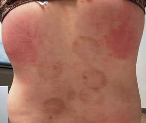 Hiperpigmentacion residual secundaria a «cupping».