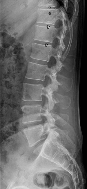 Nódulos de Schmorl en columna lumbar (flechas).