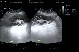 Ecografía abdominal (zona de hipocondrio derecho).